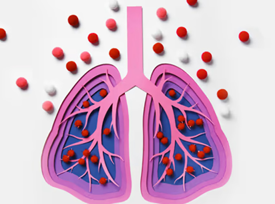 🫁 Pneumonia: A Serious Lung Infection
